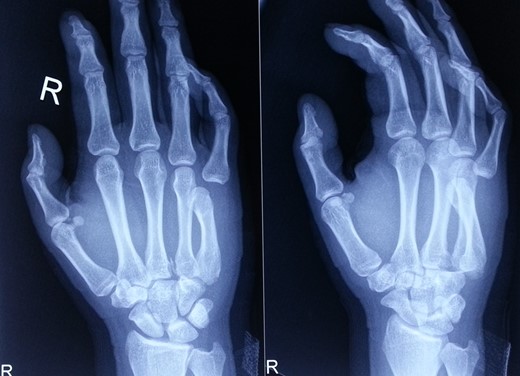 Radiograph showing pre-reduction floating fifth metacarpal.