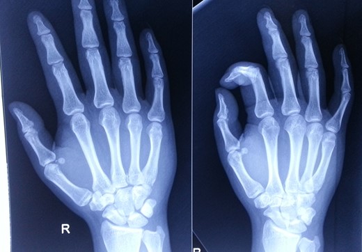 Post-reduction radiograph.