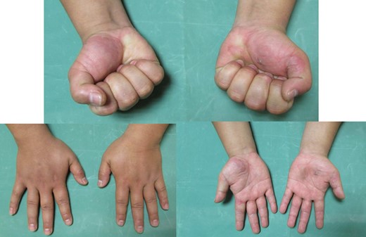 Shows ROM at 6 months follow-up.