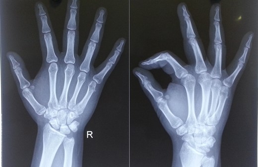 Radiographs of the fifth metacarpal at 6 months follow-up.
