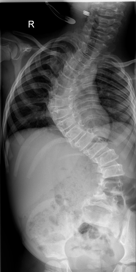 A whole spine radiograph at age 6 demonstrating the double major scoliosis (measuring 80° in the thoracic curve and 65° in the thoracolumbar curve with a T1–S1 height of 232 mm and T1–T12 height of 150 mm).