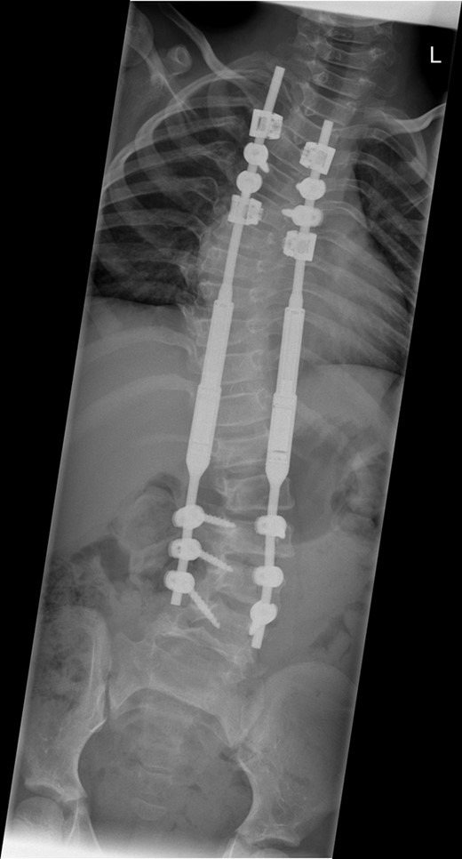 An immediate post-operative whole spine radiograph demonstrating the spinal construct with the MCGR rods (measuring 38° in the thoracic curve and 30° the thoracolumbar curve with a T1–S1 height of 247 mm and a T1–T12 height of 160 mm).