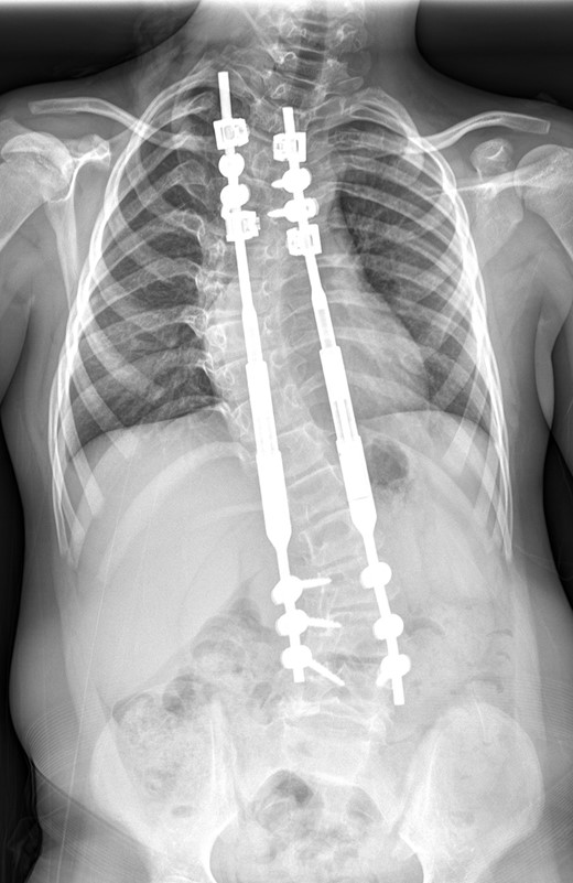A whole spine radiograph at age 8 following multiple lengthening procedures showing elongation of the MCGR rods (measuring 40° for the thoracic curve and 37° for the thoracolumbar curve with a T1–S1 height of 288 mm and T1–T12 height of 195 mm).