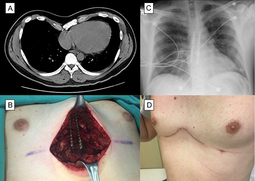 Patient with pectus excavatum. (A) Computed tomography of the patient with pectus excavatum. (B) Intraoperative view after correction of pectus excavatum and placement of sternal plates. (C) Chest X-ray after surgery showing the two sternal plate. (D) Photograph of the chest at 1 month follow up visit.