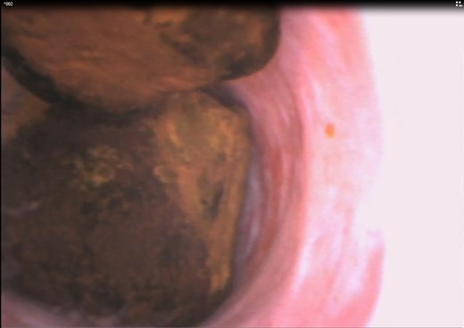 Choledochoscopic view of bile duct stones.