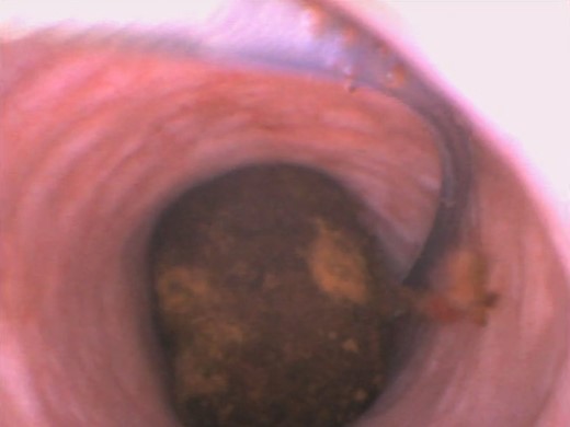 Insertion of Dormia basket for stone retrieval.