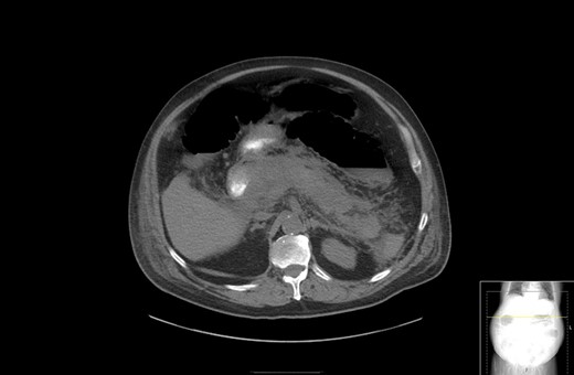 CT with oral contrast showing extensive stranding and ill-defined fluid attenuation surrounding his pancreas.