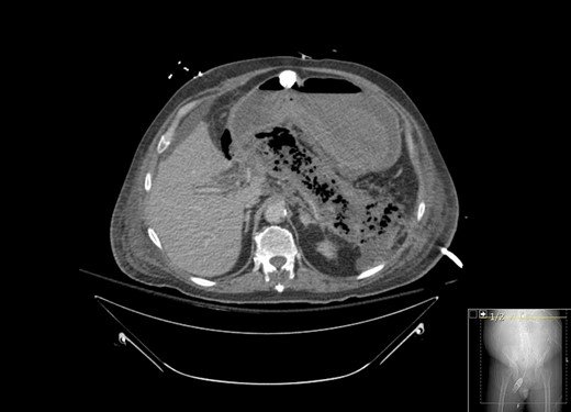 CT with contrast showing marked interval necrosis of pancreatic tissue.