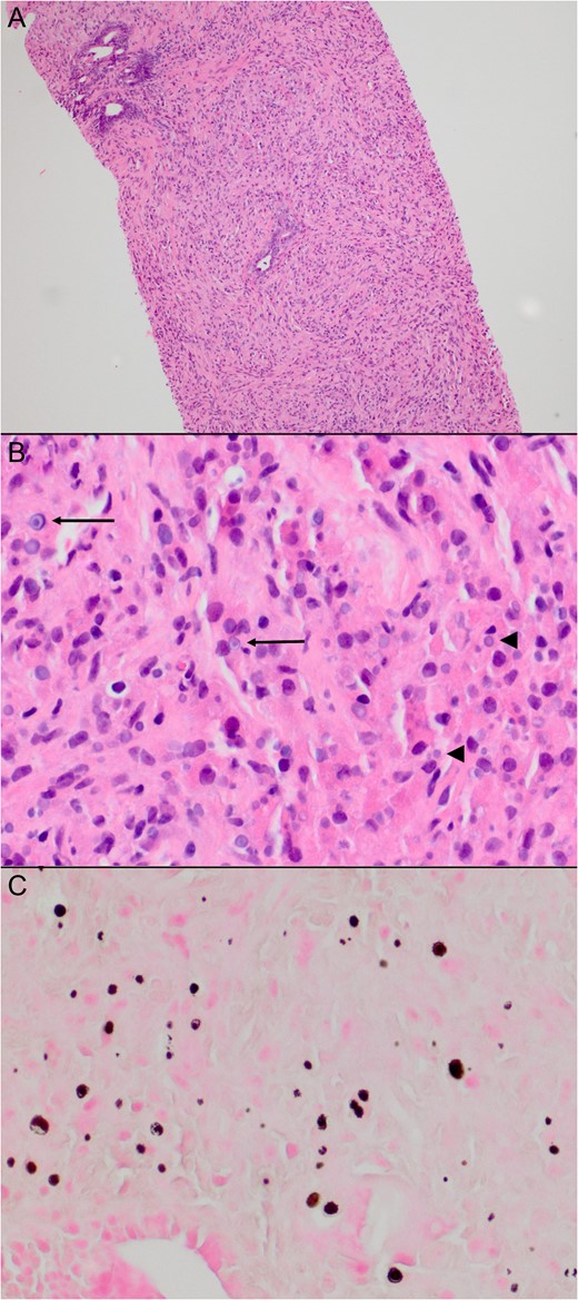 Histology of patient’s biopsy specimen. Histology of the biopsies from the left side of the prostate showed a dense inflammatory infiltrate consisting mainly of histiocytes and scattered atrophic prostatic glands (A). Many of the histiocytes contained basophilic cytoplasmic inclusions (B, arrowheads), some with a targetoid appearance (B, arrows), characteristic of Michaelis–Gutmann bodies. These are highlighted on a von Kossa stain (C).