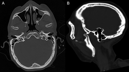 CT of the craniofacial skeleton without contrast showing the bilateral dislocation of mandibular condyles. (A) Shows as axial section and (B) sagittal section.