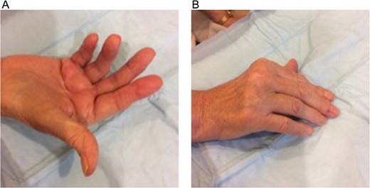 Dupuytren’s disease patient with bilateral palmar fibromatosis of >20 years duration. Inflamed palpable chords over the fourth and fifth metacarpal bones of the right-hand shows: (A) collective average active range of motion deficit of 40° in all digits (average range 30°–82.5°) and (B) inability to fully extend the digits.
