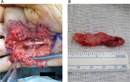 Open fasciectomy intraoperative images: (A) Raised and secured skin flaps revealing visible fibrotic contract cord overlaying the fourth metacarpal bone and (B) excised fibrotic palmar fascia specimen measuring 4.5 × 1.5 × 0.5 cm3.