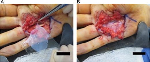 (A) The application of a 5 × 5 cm2 viable cryopreserved placental membrane. (B) The placental graft is placed proximally in the surgical dissection space overlying the metacarpophalangeal joint.
