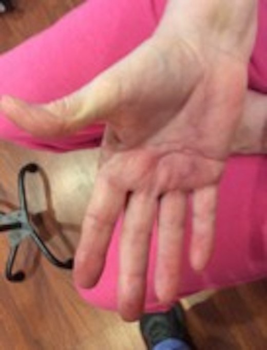 Post-operative follow-up demonstrating significant increase in range of motion (average range: 6.25°–90°) demonstrated by full extension of all digits in the right hand.