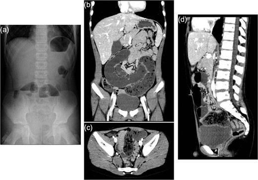 Abdominal X-ray and enhanced computed tomography. (a) Abdominal X-ray on admission showing multiple air-fluid levels. (b–d) Enhanced computed tomography showing small bowel feces sign, which is defined as the presence of feces-like material in the lumen of dilated loops of small bowel proximal to the site of obstruction.