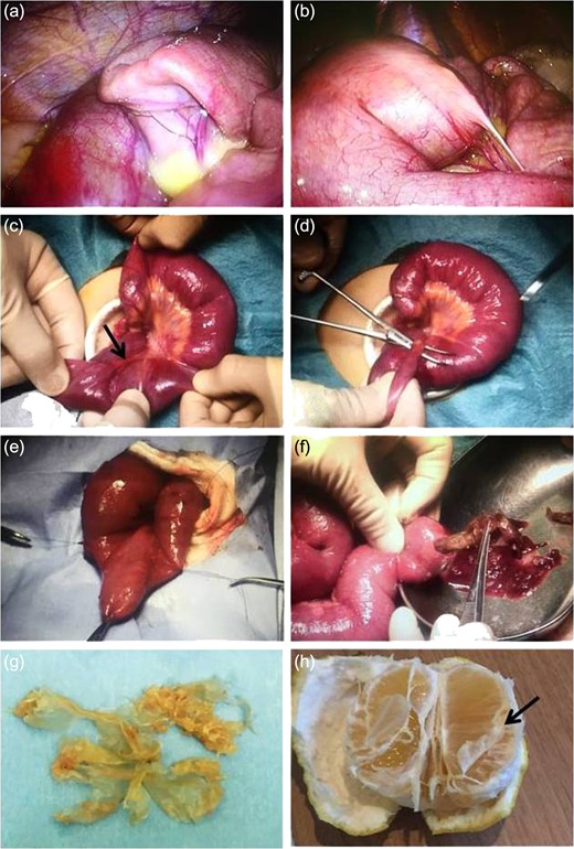 Intraoperative findings. (a) Intraoperative findings showing dilated and non-dilated segments of bowel in the ileum. (b–e) The presence of a Meckel’s diverticulum associated with a mesodiverticular band in the terminal part of dilated bowel. The Meckel’s diverticulum is tethered to the small bowel mesentery by a mesodiverticular band. (f) Intestinal contents from after Meckel’s diverticulum resection. (g) Foreign objects resembling a plastic bag, revealing the locular membranes of citrus fruit (Citrus maxima). (h) Picture showing an example of the fruit eaten by the patient (arrow: locular membrane).