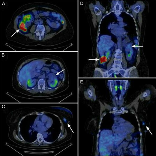 Abnormal FDG uptake in the three localisation according to the sagittal and coronal view of the PET-CT. Axial view shows (A) the colon ascendens tumour, (B) the left kidney tumour and (C) the left breast tumour. Coronal view shows (D) the left kidney tumour and the colon tumour and (E) the left breast tumour.