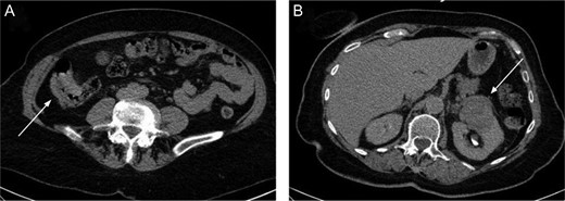 The right colon mass (A) and the left kidney mass (B) on the CT scan.