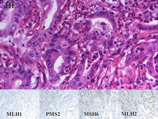 Mucinous adenocarcinoma of the colon. Panel with four columns and two rows. Upper row shows HE staining, lower rows show microsatellite instability with IHC. All of the same 40× magnification.