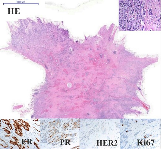 Adenocarcinoma of the left breast. Panel with four columns and three rows. Upper rows show HE staining in the centre 0.5× and on the upper-right corner 40× magnification. Lower rows show IHC all of the same 40× magnification. Oestrogen receptor 100% positive (Q-score 7–8), progesterone receptor 70% positive (Q-score 3–4), Her2 negative (Q-score 0), Ki67 index 5%.