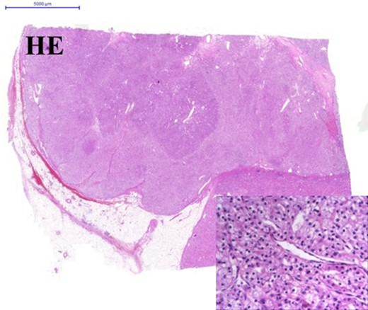 Clear cell carcinoma of the left kidney. Panel with two rows show HE staining. Image in the centre 0.5× and on the lower-right corner 40× magnification.