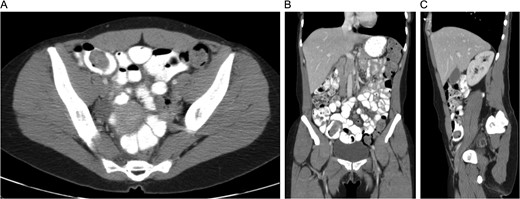 CT with oral and IV contrast of the abdomen and pelvis in axial (A), coronal (B) and sagittal (C) views.