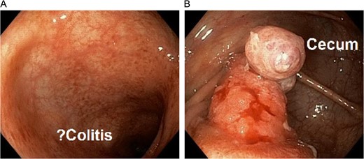 Colonoscopy demonstrating questionable active colitis in the ascending colon (left) and a mass in the cecum (right).