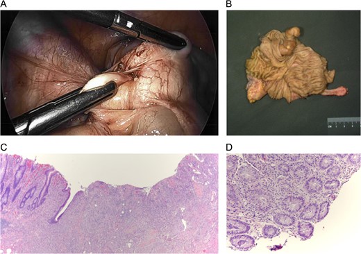 (Top left) Laparoscopic identification of the cecum with invagination of the appendix. (Top right) Ileocecectomy gross specimen with intussuscepted appendix within the cecum. (Bottom left) Microscopic section of the appendix with ulceration of the mucosa. (Bottom right) Biopsy of left colon demonstrating cryptitis and crypt abscesses.