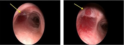 Bronchoscopic imaging.