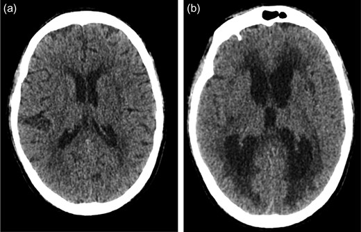 (a) Initial CT head scan performed did not show evidence of hydrocephalus. (b) Post-operative CT head showing new onset acute hydrocephalus.