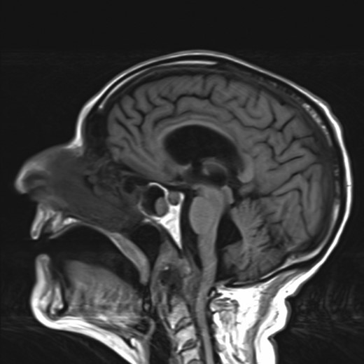 MRI head showing a large tissue mass and erosion of the odontoid causing CSF outflow obstruction at the cervico-medullary junction.