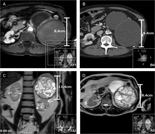 (A and B) Represent contrast and non-contrast enhanced CT scans from 2014 of the left upper pole cyst when it was noted that the patient complained of 6 months of weight loss. The CT findings indicated the upper pole cyst to still be classified as Bosniak stage IIF. There is no notable calcification, septations or convincing solid components. (C and D) Both represent the MRI of the upper pole cyst. The findings images demonstrate extensive, thick septations in the upper pole cyst upgrading the cyst to Bosniak stage III. The scans outline the limitations of surveillance CT vs MRI to stage the severity of renal cystic disease in this patient.