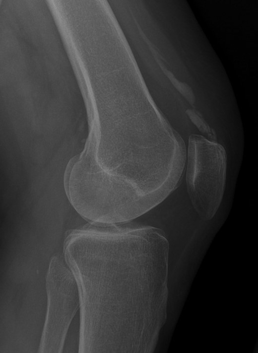 Weight-bearing lateral radiograph of the patient’s knee shows extensive mineralization of the quadriceps tendon.
