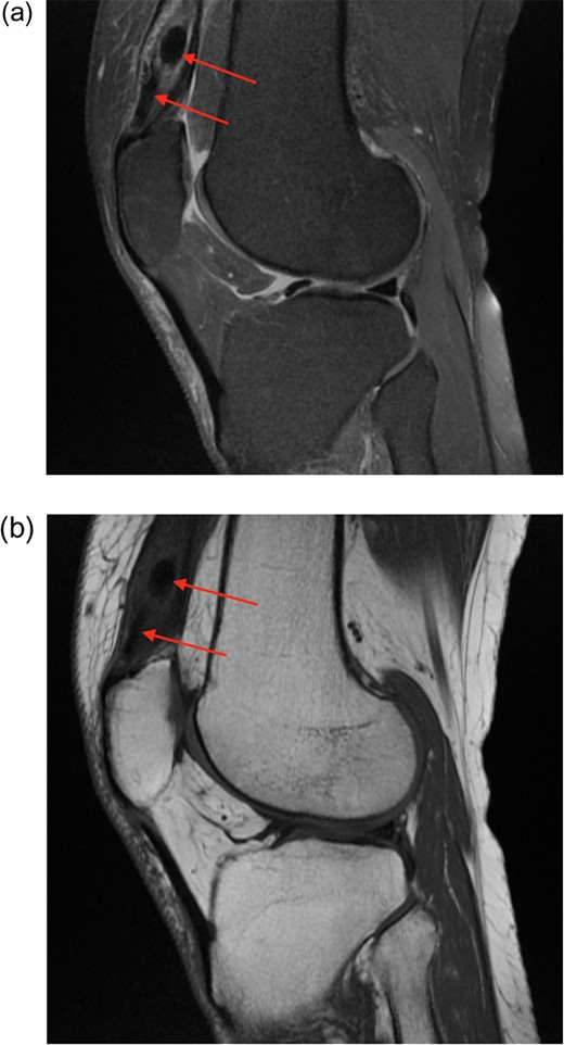 (a) Proton density fat saturated (PDfs) sagittal MRI. There is enlargement of the distal quadriceps tendon, with splayed fibres separated by solid low signal foci. (b) T1 sequence MRI also showing low signal lesions.