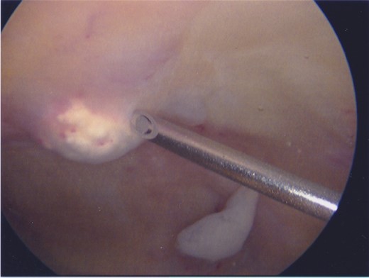 The supra-patellar pouch of the knee during arthroscopy. A focus of calcification is seen protruding into the joint, left of the tip of the needle. Note the erythematous synovitis overlying the calcification. Loose material below the needle shaft is believed to be fibrotic synovium.