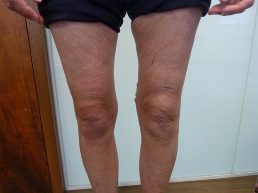 The patient’s knees 10 months after surgery. Note the healed incision on the left knee.
