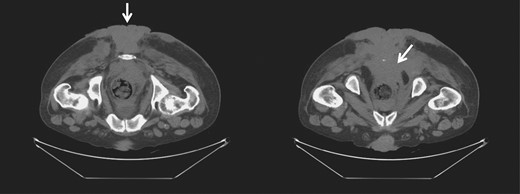 CT of the pelvis and perineum showing the BLT invading the rectum and anal canal.