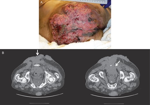 Gross image (A) and CT of the pelvis and perineum (B) showing exacerbation of the tumor with significant necrosis and invasion into the rectum and anal canal.