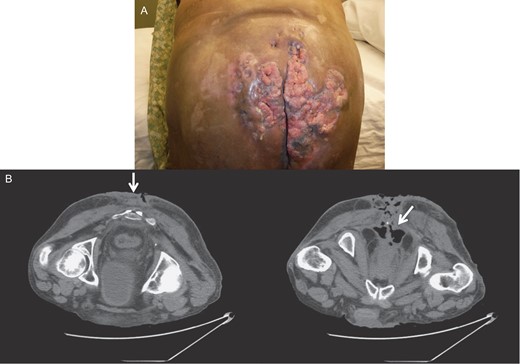 Gross image (A) and CT of the pelvis and perineum (B) showing tumor resolution and residual lesions after chemoradiation therapy.