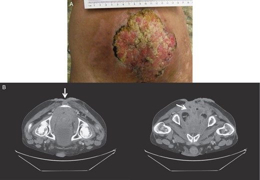 Gross image (A) and CT of the pelvis and perineum (B) showing tumor recurrence.