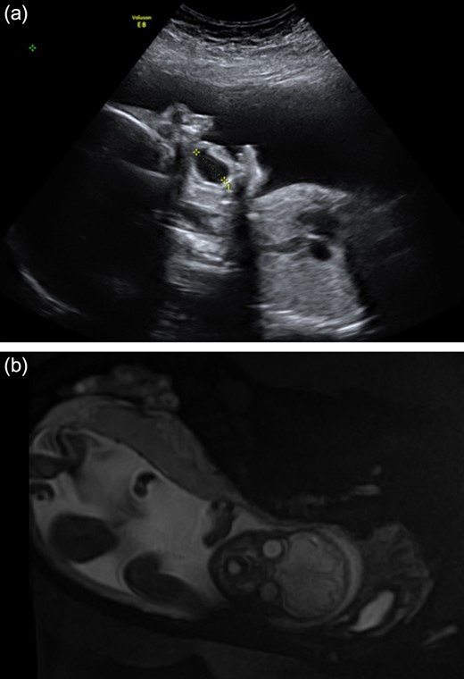 (a) and (b) Antenatal ultrasound at 28 weeks and MRI scan at 31 weeks demonstrating large fluid-filled oral cyst.