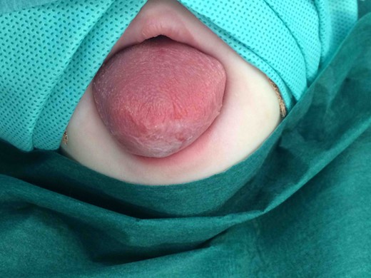 Pre-operative photograph of superior aspect of tongue demonstrating significant tongue swelling, resulting in the tongue protruding past the lips.