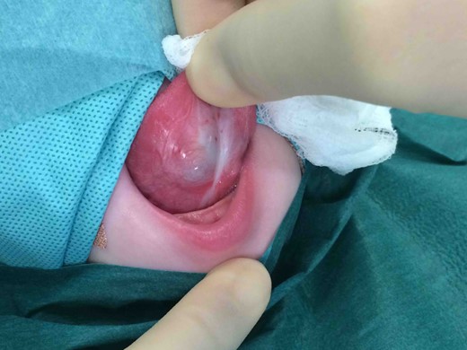 Pre-operative photograph of inferior aspect of tongue.