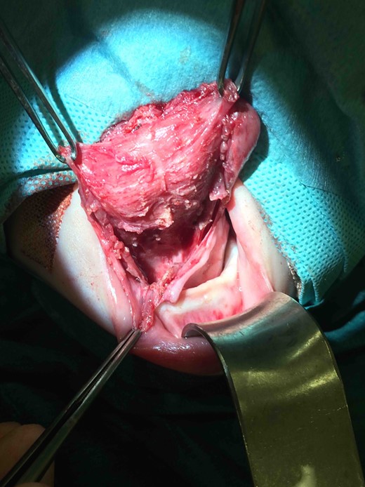 Intraoperative photograph demonstrating surgical excision of the thryoglossal duct cyst.