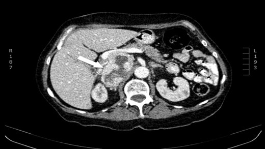 CT scan (axial) of the heterogenous solid nodule with 70 × 49 × 87 mm3 with peripheral contrast enhancement and central necrosis (white arrow).