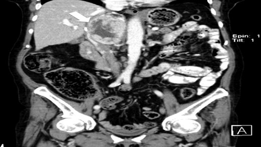 CT scan (coronal) of the heterogenous solid nodule (white arrow).
