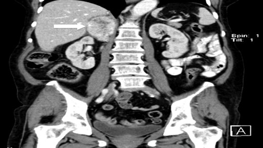 CT scan (coronal) of the heterogenous solid nodule adjacent to upper inner right renal pole (white arrow).