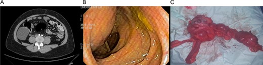 (A) CT revealing a 7 × 8 cm2 cystic lobulated mass dependent of the cecum wall. (B) Colonoscopy showing extrinsic compression of the lateral wall of the ascending colon. (C) Colonic mass and right colon.