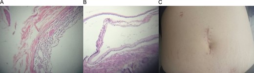 (A) Microscopic view of the cystic wall. (B) Normal colonic wall adjacent to the cystic wall. (C) Midline incision after recovery.