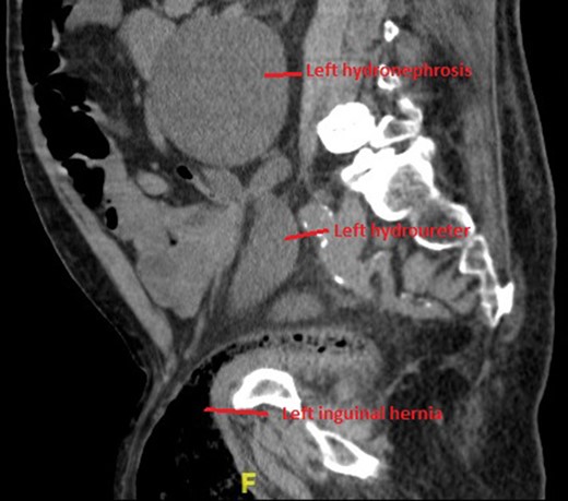 Sagittal section of CT demonstrating large left hydronephroureter and left inguinal hernia.